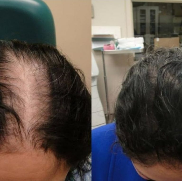 PRP Treatment for hair loss